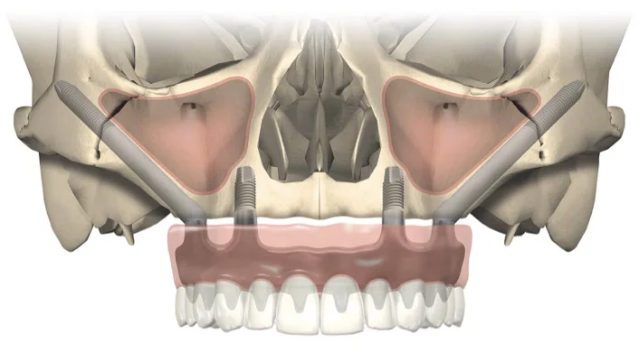Schematische Darstellung einer Hybridversorgung mit zwei Zygoma-Implantaten